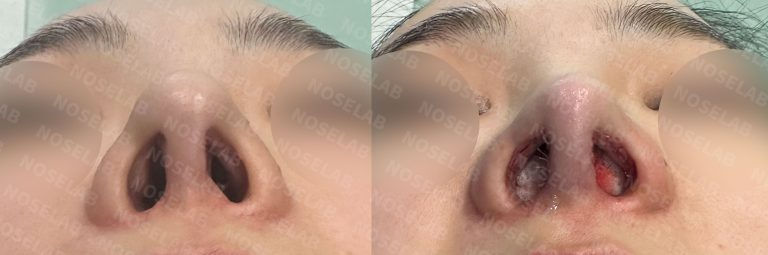 Basal view before and after Mild Contracted Nose Correction