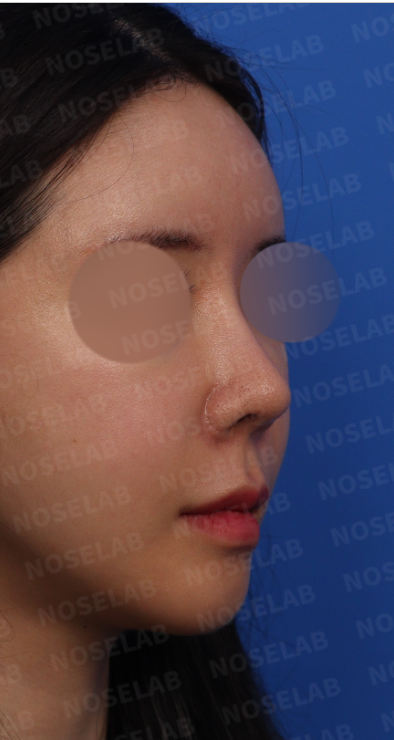 Revision rhinoplasty Korea – preoperative 45-degree view of upturned and deviated nose