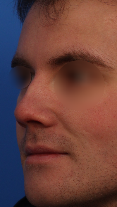 Preoperative 45-degree view showing blunt nose tip and wide nasal bridge before rhinoplasty