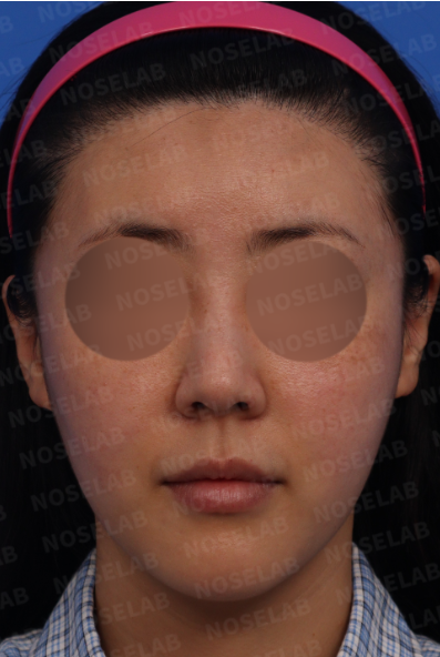 Frontal view