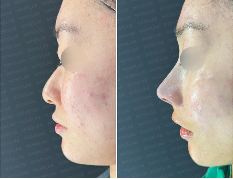 Side view before and after closed rhinoplasty in Korea – natural correction of bulbous tip and crooked nose using autologous rib cartilage.