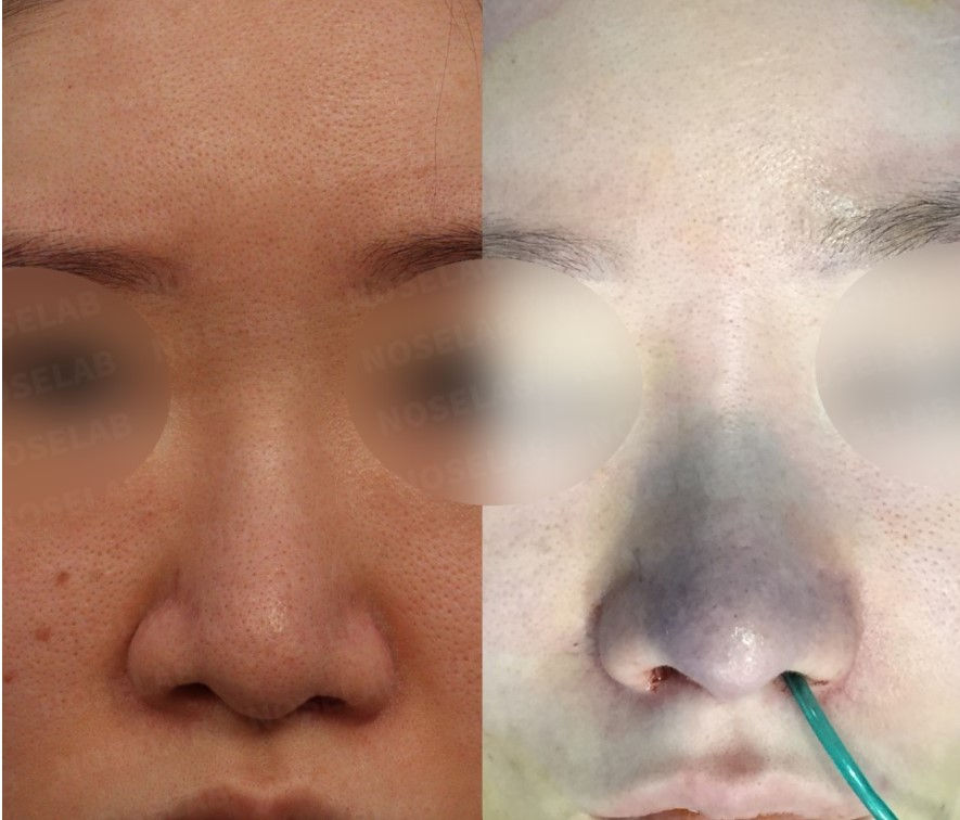 Before and after Closed Rhinoplasty Seoul – frontal view showing correction of droopy, bulbous, and deviated nose with improved nasal symmetry using autologous rib cartilage at NoseLab Plastic Surgery.