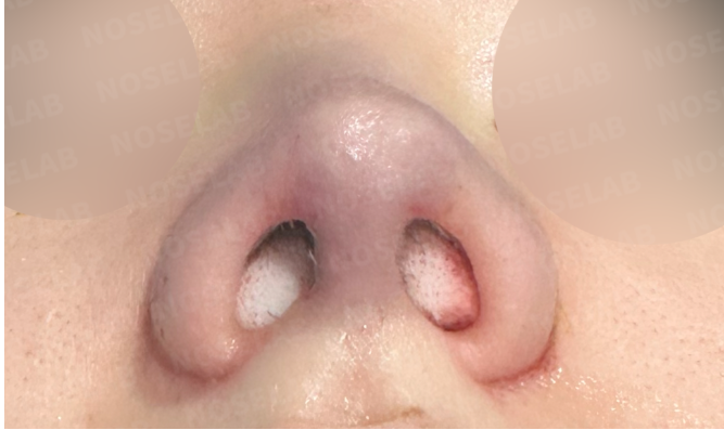 Close-up nostril view immediately after bulbous nose correction surgery at Nose Lab Clinic, showing internal structure and post-operative healing.