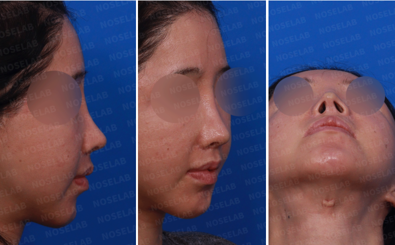 Preoperative photos before closed rhinoplasty: right side view, right oblique view, and nostril view.