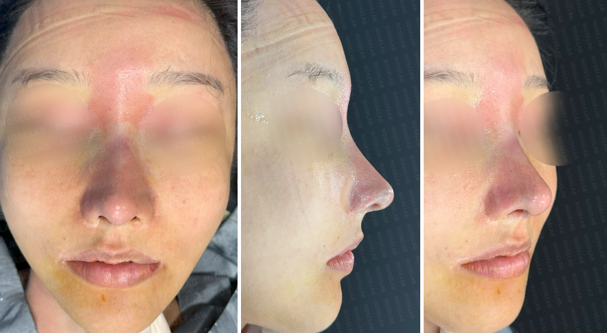 hinoplasty for long mid-face correction – immediate postoperative photos showing frontal, side, and oblique views