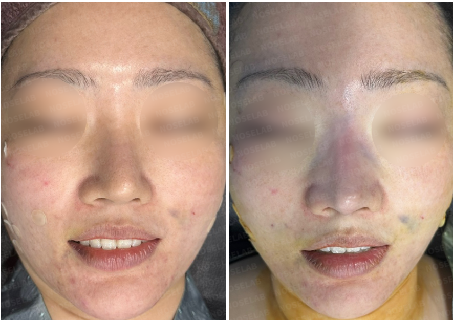 Frontal view comparison before and immediately after revision rhinoplasty on a female patient to correct nasal deviation and drooping tip.