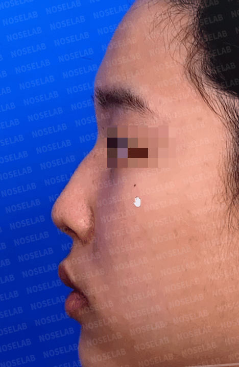 closed rhinoplasty Korea preoperative design consultation – side view showing hump nose and short nasal tip before correction