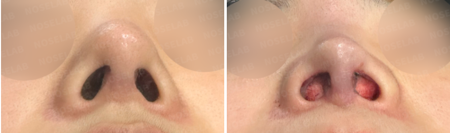Before and immediately after upturned nose correction – nostril view showing columella repositioning and improved nasal angle