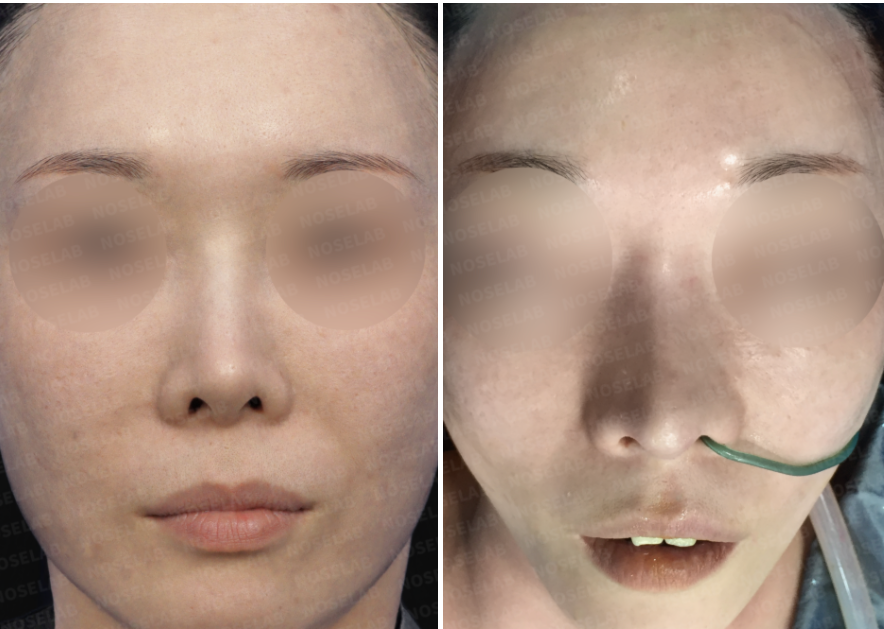 Revision rhinoplasty for short upturned nose – before and after frontal view photos