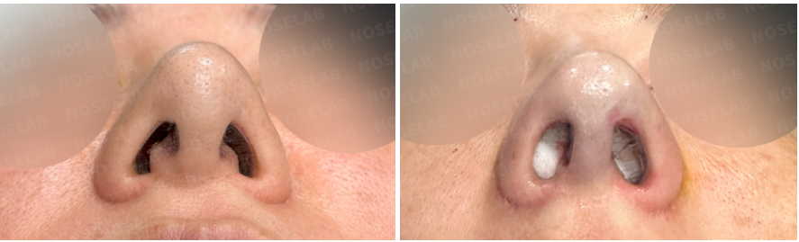 Nostril base view before and immediately after revision rhinoplasty. Correction of nostril asymmetry, wide nasal base, and columellar deviation using autologous rib cartilage.