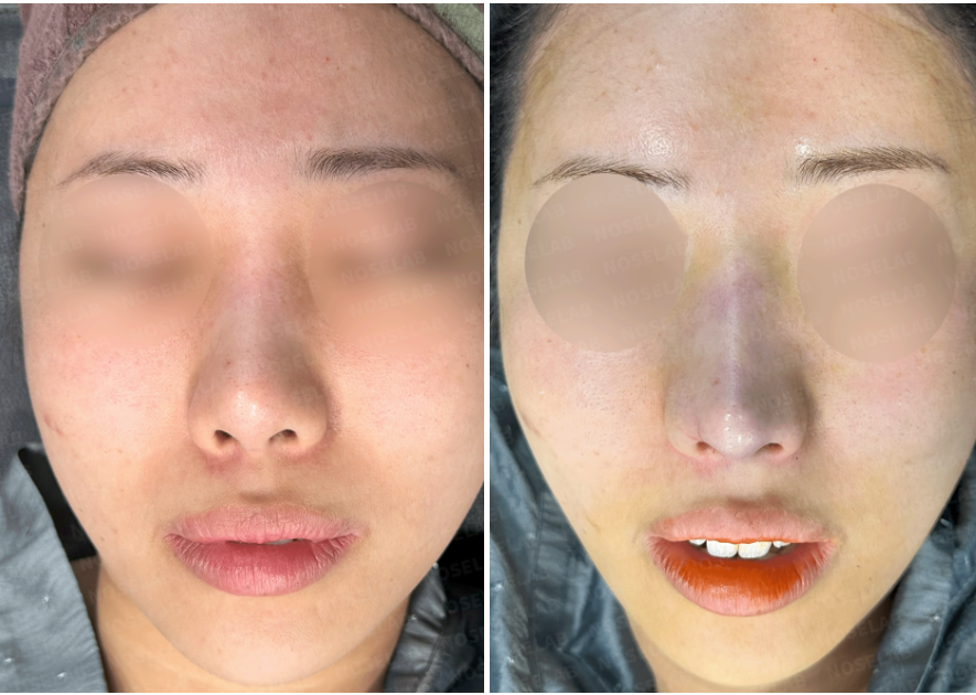 Frontal view comparison before and immediately after customized nasal reconstruction surgery – improved nasal bridge and refined tip