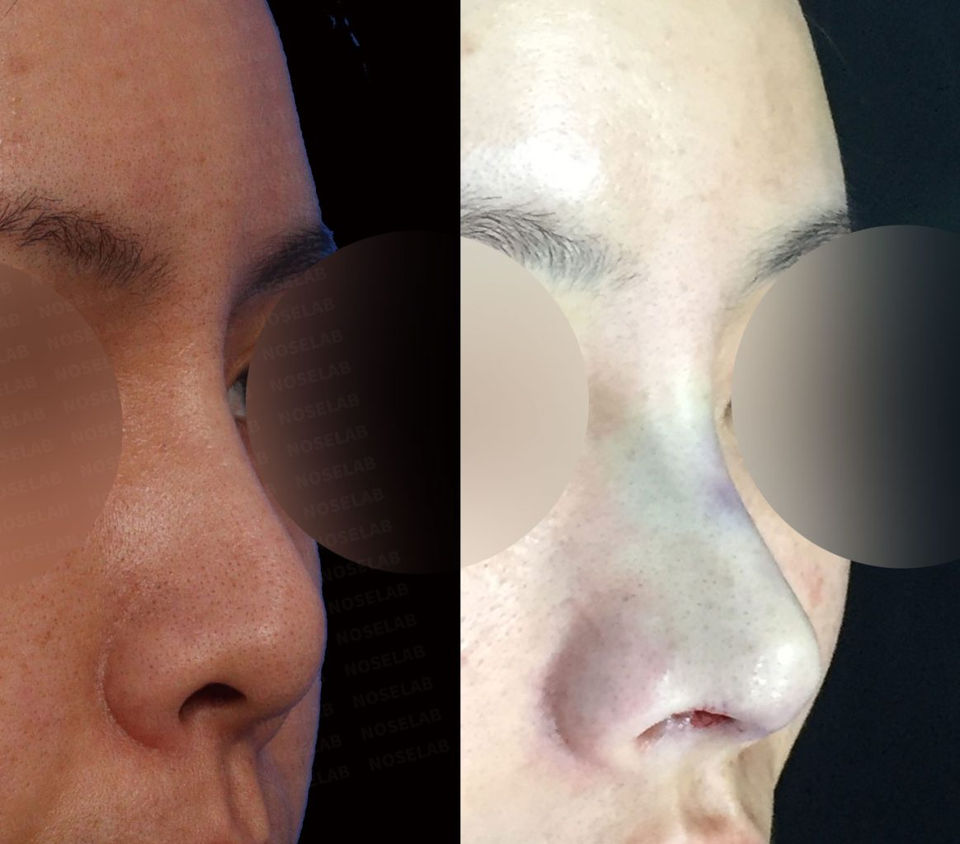 Right 45-degree before and after view showing natural nasal line after Deviated and Upturned Nose Correction – Closed Rhinoplasty Korea
