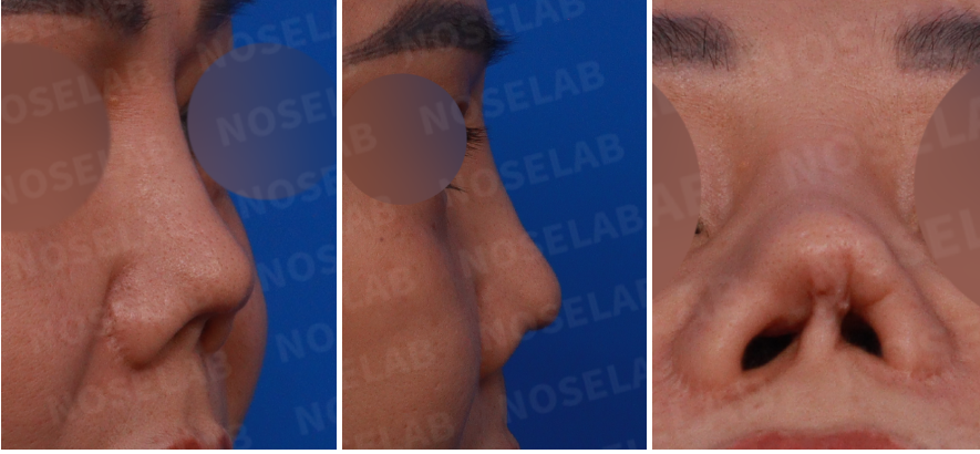 preoperative right side, oblique, and nostril views of severe contracted nose with columella retraction and asymmetry before closed rhinoplasty Korea
