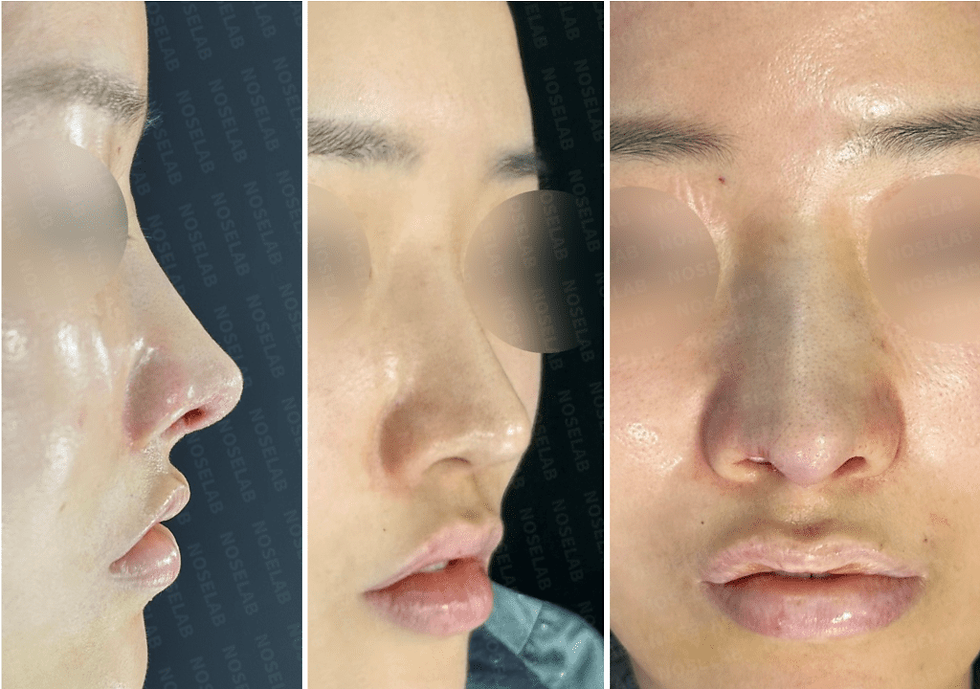 90° angle | 45° angle | Frontal view. Photos taken after the surgery with the consent of the patient. 