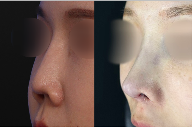 Before and after oblique 45-degree photos highlighting the improved nasal bridge line, refined tip projection, and natural three-dimensional balance.
