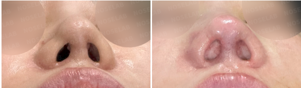Nostrils before surgery (left) after surgery (right)