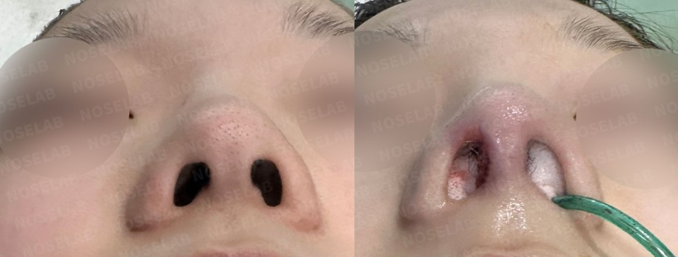 Base view showing correction of nostril asymmetry and improved columella alignment after closed deviated nose correction surgery (Noselab Clinic)