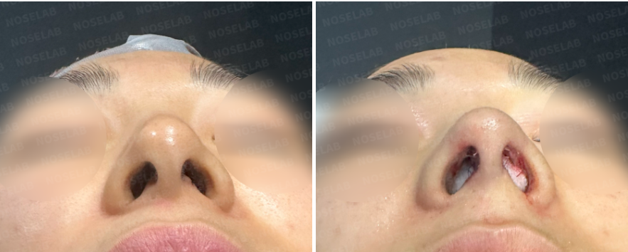 Nostrils before surgery (left) after surgery (right)