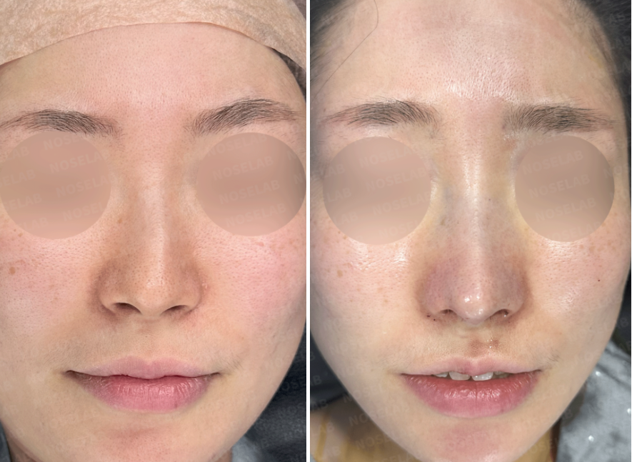 Frontal view before (left) and immediately after (right) hump nose and deviated nose correction – Nose Lab Clinic