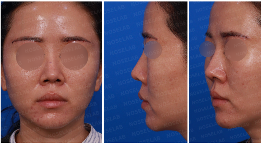 Design consultation photos: frontal, left oblique, and side view before columella depression correction surgery