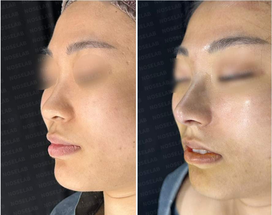 Oblique view comparison showing the patient before surgery (left) and immediately after straight-line rhinoplasty with bulbous tip refinement (right)