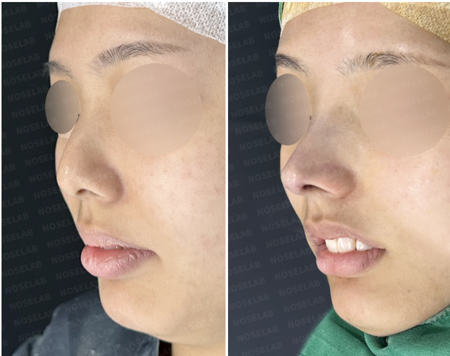 Crooked hump nose correction Korea oblique view before and after with refined nasal tip
