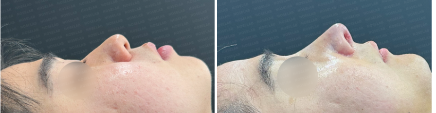 Before and immediately after Short and Low Nasal Bridge Rhinoplasty: side profile showing natural bridge augmentation, dorsal hump reduction, and elevated nasal tip.