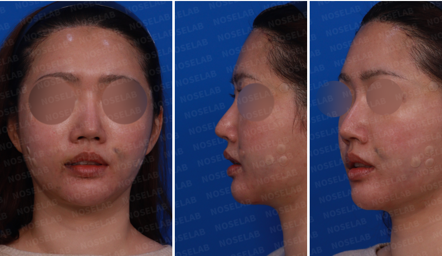 Design consultation images showing a female patient’s nose from the front, left side, and oblique angle before rhinoplasty surgery.