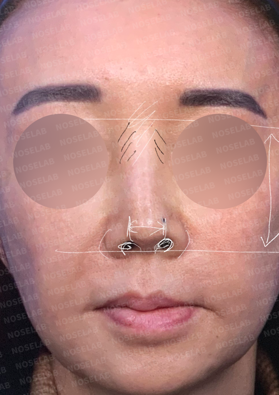 Frontal facial photograph with rhinoplasty planning annotations showing nasal deviation assessment and symmetry guidelines