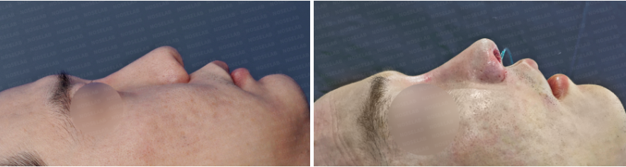 Before and immediately after Revision Rhinoplasty for Nasal Asymmetry and Nostril Correction – side view comparison showing improved nasal bridge alignment, lifted tip, and reduced columella retraction.