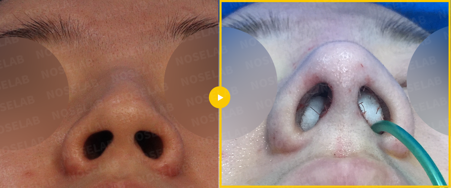 Basal view comparison demonstrating corrected nostril asymmetry and columellar repositioning