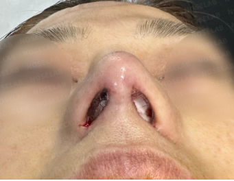 Immediate post-surgery nostril view showing correction of asymmetry and improved nasal tip support after rib cartilage reconstruction