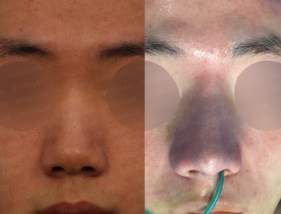 closed rhinoplasty Korea before and after front view – bulbous and short nose correction and nasal asymmetry improvement (Left: before surgery, Right: immediately after surgery)