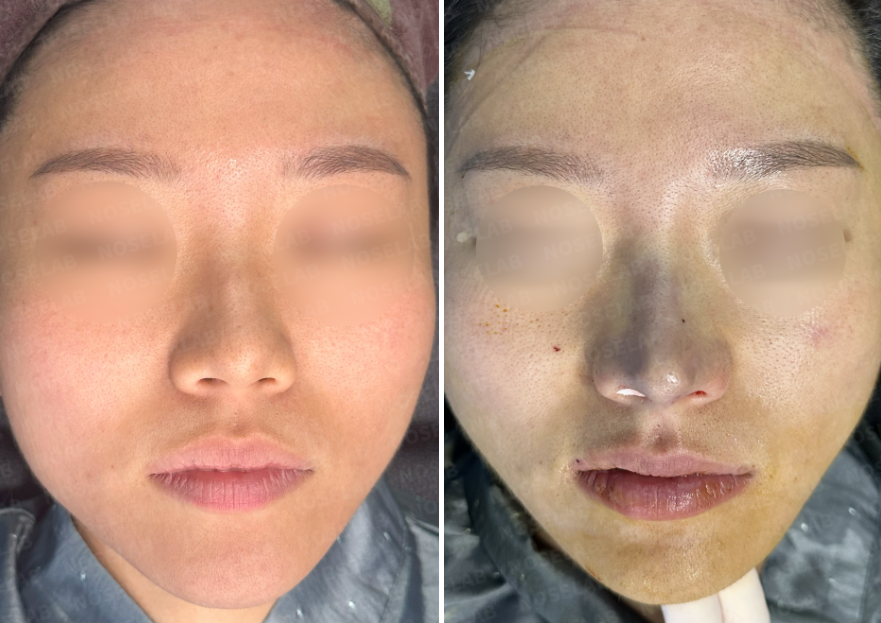 Upturned nose correction Korea before and after surgery – frontal comparison view