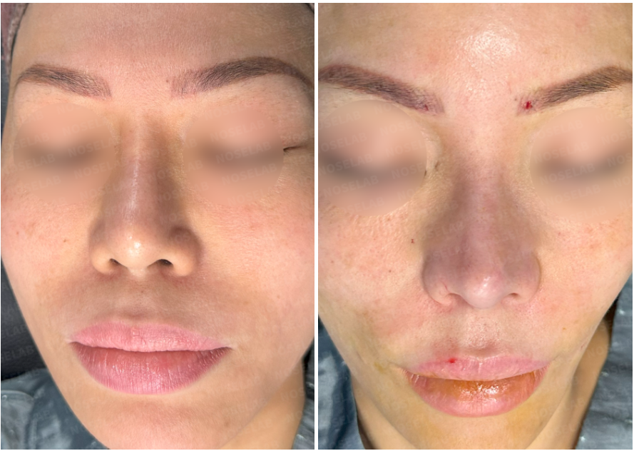 Silitex implant removal rhinoplasty revision – frontal view before surgery (left) and immediately after surgery (right)