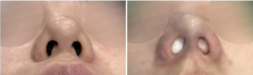 Nostril view before and immediately after closed rhinoplasty Korea for bulbous nose correction