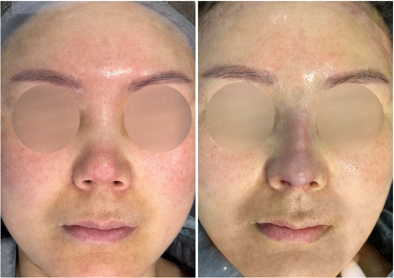 Before surgery (left), after surgery (right)