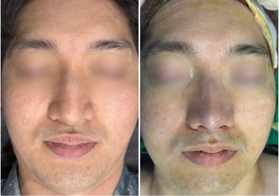 Before and immediately after autologous rib cartilage rhinoplasty – frontal view showing dorsal hump correction, nasal tip refinement, and improved symmetry.