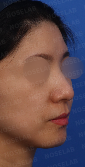 Preoperative 45-degree angle view of wide and bulbous nose tip before bulbous nose rhinoplasty in Korea