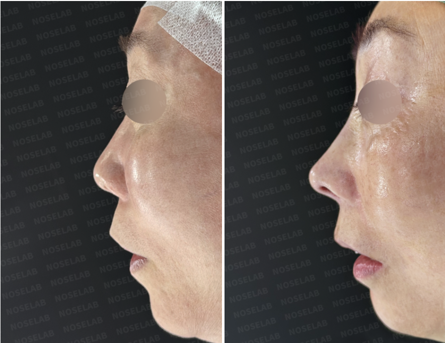 Before and immediately after side profile comparison following closed rhinoplasty Korea, showing refined nasal tip projection, smoother dorsal line, and improved overall nasal balance.