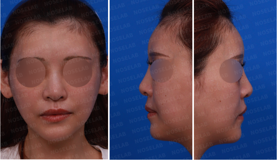 Pre-surgery design consultation photos for mesh removal rhinoplasty: frontal view and both side views showing bulbous nasal tip and asymmetry.