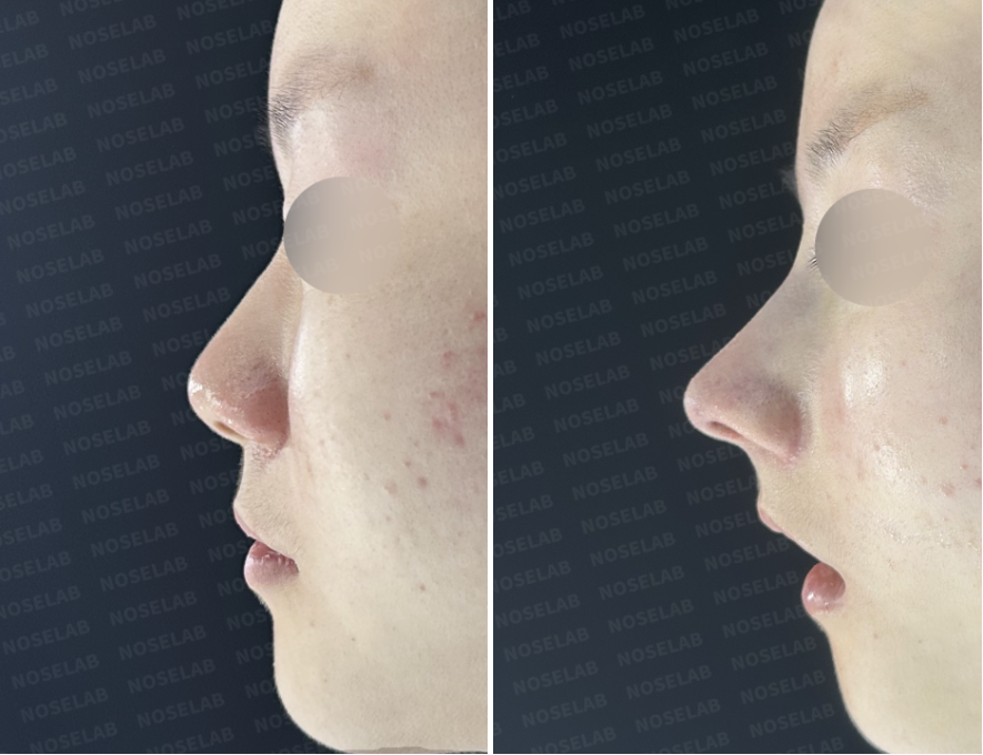 Left lateral view comparison showing preoperative nasal profile on the left and immediate postoperative appearance on the right after refinement of the nasal bridge and nasal tip support.