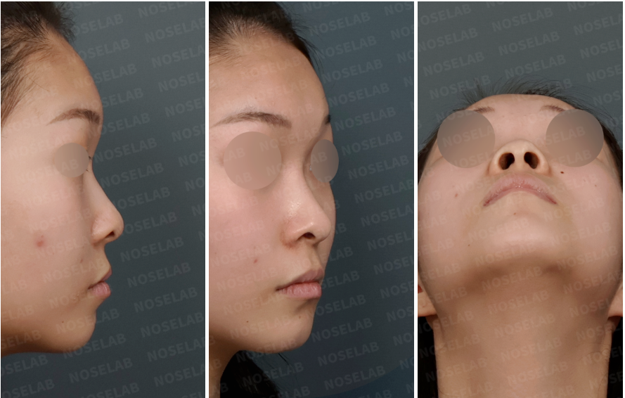 Preoperative consultation photos showing right side profile, right oblique view, and nostril view of a patient with a low nasal bridge and wide nasal tip before closed rhinoplasty.