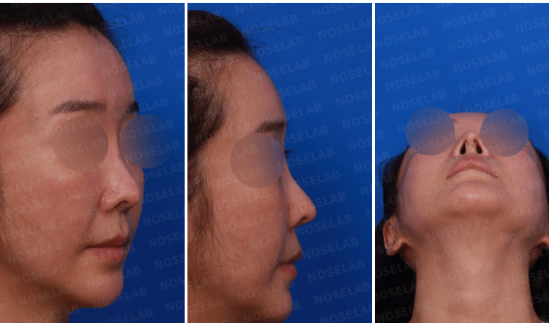 reoperative design consultation photos for complex revision rhinoplasty – right oblique side, right side, and nostril views of female patient