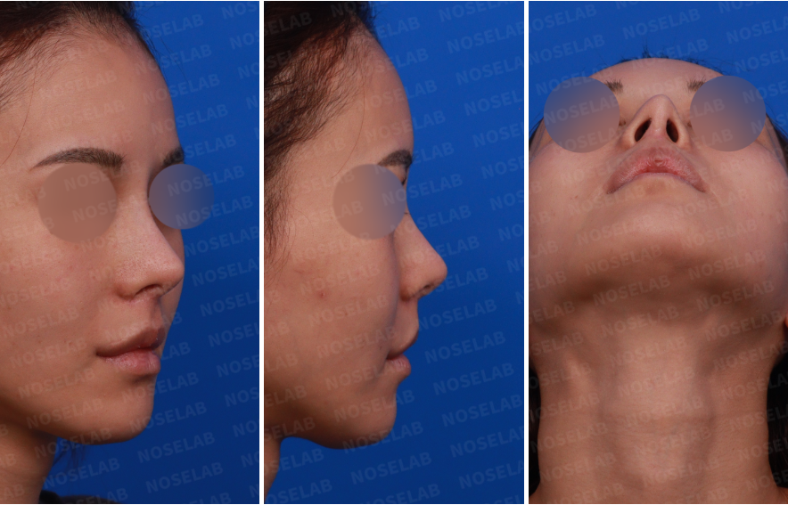 Pre-surgery consultation photos for deviated nose correction: oblique, side, and nostril views.