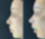 Nostril asymmetry correction Korea before and after surgery – side profile view