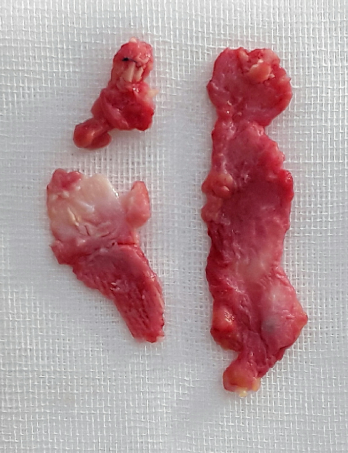 Photograph from the archive: Permanent Filler Removal and Nose Reconstruction Using Closed Rhinoplasty (image 1)