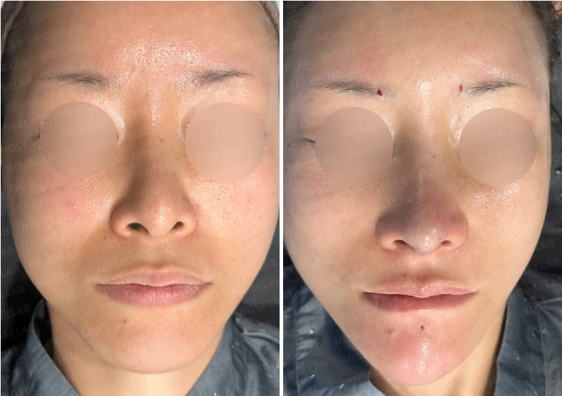 Before and immediately after surgery: Frontal view showing improvement in nasal tip drooping and columella narrowing correction.