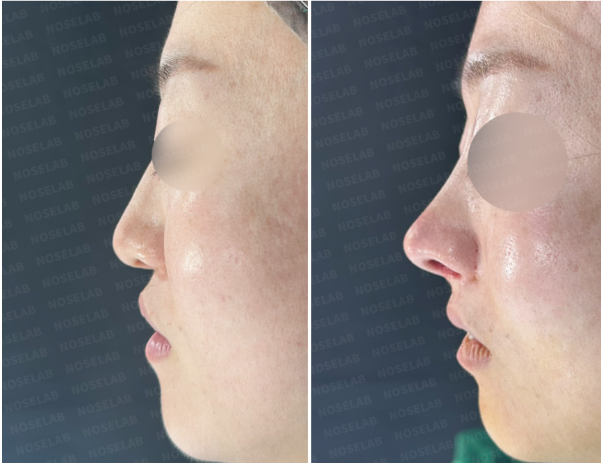 Lateral view comparison before (left) and immediately after (right) revision rhinoplasty highlighting shortened nasal length, corrected tip drooping, and improved nasolabial angle.