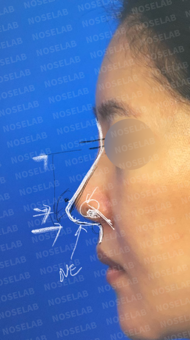 Lateral profile assessment showing nasal tip rotation and dorsal contour evaluation before corrective procedure in Seoul